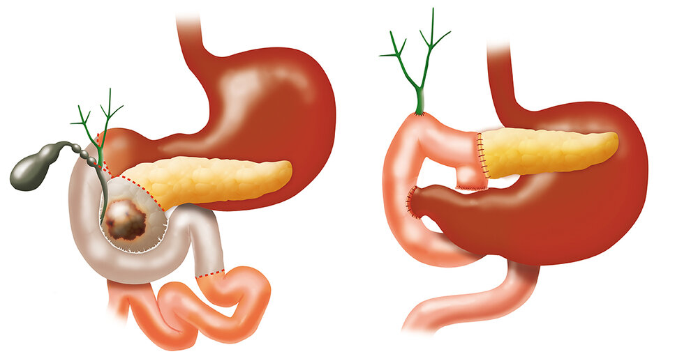 LAPAROSCOPY