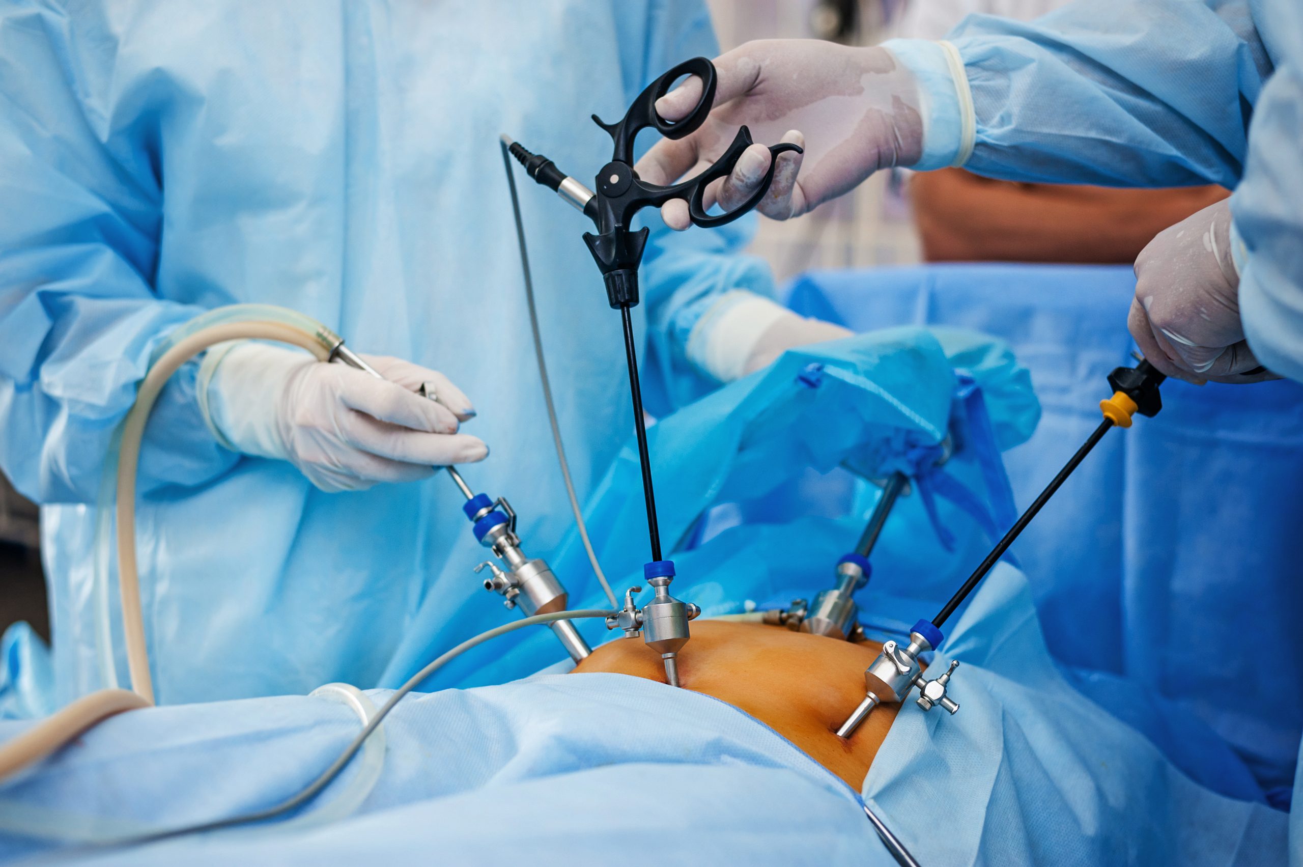 LAPAROSCOPY