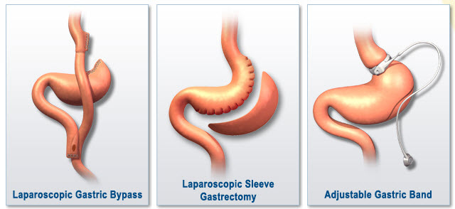 OBESITY SURGERY