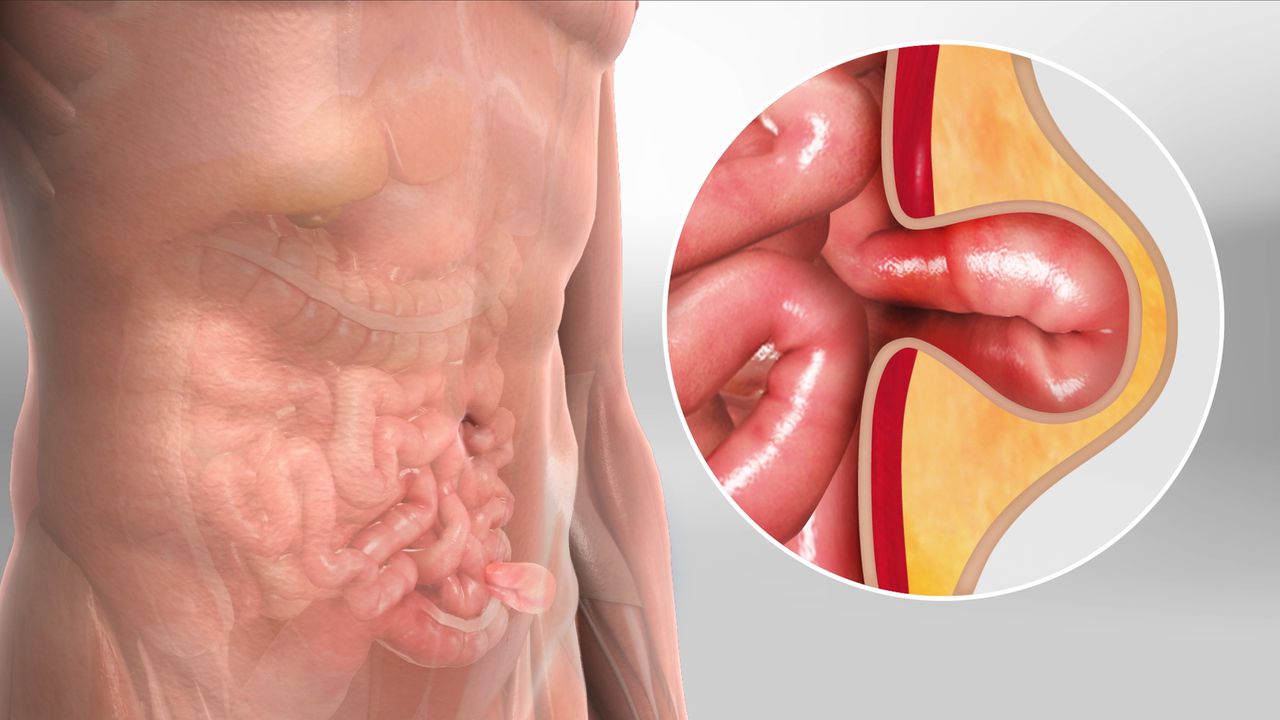 laparoscopic hernia surgery