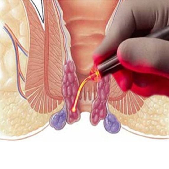 OBESITY SURGERY